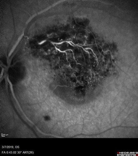 Branch Retinal Vein Occlusion with Edema - Failed avastin (bevacizumab) and did well with Eylea (Aflibercept)
67 year old female The vision in the left eye was good until about 4 months ago.Â  Prior to that it was OK.Â  The vision in the right eye is fine.Â  She is not sure if she has had strokes from studies taken in December.Â  She was, at that time, sent to the ER for high blood pressure.Â Â 
VA OD: Dcc20/40 OS: 20/100
Four treatments with Avastin she was still 20/100 with edema.  With two Eylea treatments she improved to 20/32 and has remained dry and with good vision
