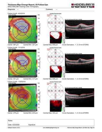 Branch Retinal Vein Occlusion with Edema - Failed avastin (bevacizumab) and did well with Eylea (Aflibercept)
67 year old female The vision in the left eye was good until about 4 months ago.Â  Prior to that it was OK.Â  The vision in the right eye is fine.Â  She is not sure if she has had strokes from studies taken in December.Â  She was, at that time, sent to the ER for high blood pressure.Â Â 
VA OD: Dcc20/40 OS: 20/100
Four treatments with Avastin she was still 20/100 with edema.  With two Eylea treatments she improved to 20/32 and has remained dry and with good vision
