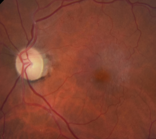 Vascular Remodeling Bilateral BRVO
85 year old female 20/25 OU with BRVO 7 years ago in both eyes.  She has a change in vision.  The FA shows extensive collaterallization and vascular remodeling in each macula.
