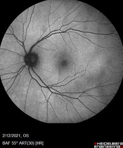 Branch Retinal Vein Occlusion with Venous Macroaneurysm (collateral)
66 year old female Did not notice vision loss in the right eye.  The right eye has been a little worse than the left but now is much worse.  Picked up during annual eye examination.  VA had been 20/20 in 5 years ago.
History of brain and spinal cord radiation 1986 for T-cell lymphoma.  Now with breast cancer, ablation for tachycardia, HTN
VA OD 6/200, OS 20/32
