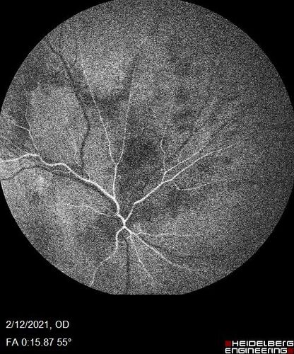 Branch Retinal Vein Occlusion with Venous Macroaneurysm (collateral)
66 year old female Did not notice vision loss in the right eye.  The right eye has been a little worse than the left but now is much worse.  Picked up during annual eye examination.  VA had been 20/20 in 5 years ago.
History of brain and spinal cord radiation 1986 for T-cell lymphoma.  Now with breast cancer, ablation for tachycardia, HTN
VA OD 6/200, OS 20/32
