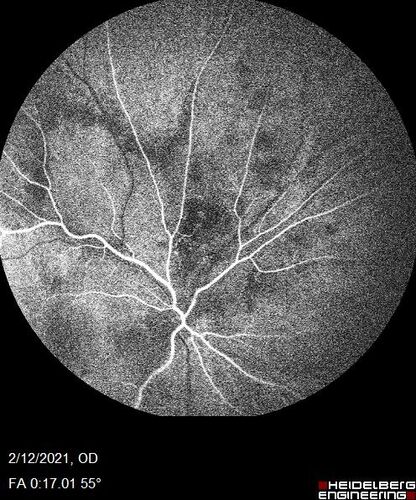 Branch Retinal Vein Occlusion with Venous Macroaneurysm (collateral)
66 year old female Did not notice vision loss in the right eye.  The right eye has been a little worse than the left but now is much worse.  Picked up during annual eye examination.  VA had been 20/20 in 5 years ago.
History of brain and spinal cord radiation 1986 for T-cell lymphoma.  Now with breast cancer, ablation for tachycardia, HTN
VA OD 6/200, OS 20/32
