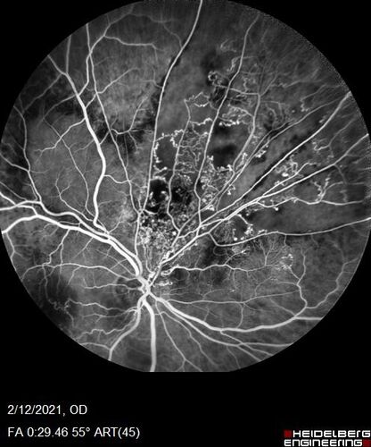 Branch Retinal Vein Occlusion with Venous Macroaneurysm (collateral)
66 year old female Did not notice vision loss in the right eye.  The right eye has been a little worse than the left but now is much worse.  Picked up during annual eye examination.  VA had been 20/20 in 5 years ago.
History of brain and spinal cord radiation 1986 for T-cell lymphoma.  Now with breast cancer, ablation for tachycardia, HTN
VA OD 6/200, OS 20/32
