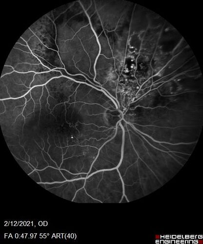 Branch Retinal Vein Occlusion with Venous Macroaneurysm (collateral)
66 year old female Did not notice vision loss in the right eye.  The right eye has been a little worse than the left but now is much worse.  Picked up during annual eye examination.  VA had been 20/20 in 5 years ago.
History of brain and spinal cord radiation 1986 for T-cell lymphoma.  Now with breast cancer, ablation for tachycardia, HTN
VA OD 6/200, OS 20/32
