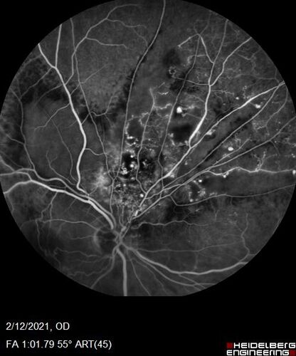 Branch Retinal Vein Occlusion with Venous Macroaneurysm (collateral)
66 year old female Did not notice vision loss in the right eye.  The right eye has been a little worse than the left but now is much worse.  Picked up during annual eye examination.  VA had been 20/20 in 5 years ago.
History of brain and spinal cord radiation 1986 for T-cell lymphoma.  Now with breast cancer, ablation for tachycardia, HTN
VA OD 6/200, OS 20/32
