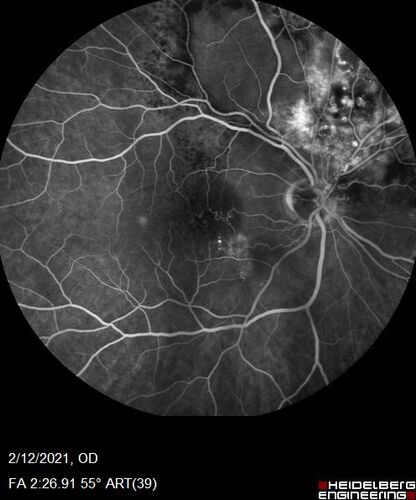 Branch Retinal Vein Occlusion with Venous Macroaneurysm (collateral)
66 year old female Did not notice vision loss in the right eye.  The right eye has been a little worse than the left but now is much worse.  Picked up during annual eye examination.  VA had been 20/20 in 5 years ago.
History of brain and spinal cord radiation 1986 for T-cell lymphoma.  Now with breast cancer, ablation for tachycardia, HTN
VA OD 6/200, OS 20/32
