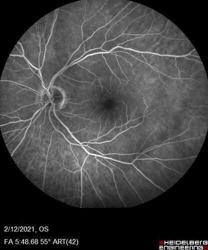 Branch Retinal Vein Occlusion with Venous Macroaneurysm (collateral)
66 year old female Did not notice vision loss in the right eye.  The right eye has been a little worse than the left but now is much worse.  Picked up during annual eye examination.  VA had been 20/20 in 5 years ago.
History of brain and spinal cord radiation 1986 for T-cell lymphoma.  Now with breast cancer, ablation for tachycardia, HTN
VA OD 6/200, OS 20/32
