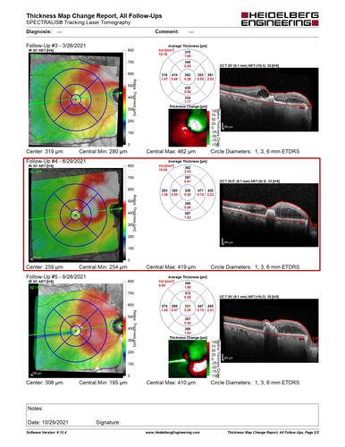 Old BRVO with venous MA - post-laser OCT Maps
