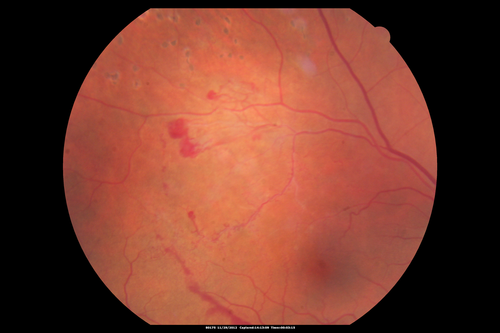 Branch Retinal Vein Occlusion with NVE (Neovascularization Elsewhere)
