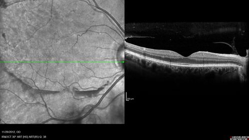 Branch Retinal Vein Occlusion with NVE (Neovascularization Elsewhere)
