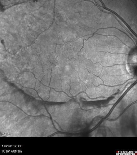 Branch Retinal Vein Occlusion with NVE (Neovascularization Elsewhere)
