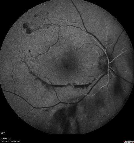 Branch Retinal Vein Occlusion with NVE (Neovascularization Elsewhere)
