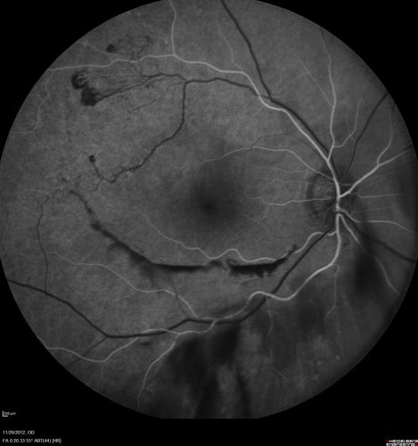 Branch Retinal Vein Occlusion with NVE (Neovascularization Elsewhere)
