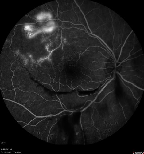 Branch Retinal Vein Occlusion with NVE (Neovascularization Elsewhere)
Late Leakage on FA - NV is adjacent to non-perfusion
