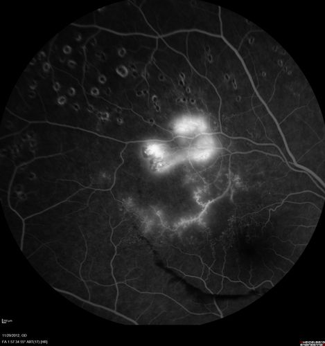 Branch Retinal Vein Occlusion with NVE (Neovascularization Elsewhere)
Late Leakage on FA - NV is adjacent to non-perfusion
