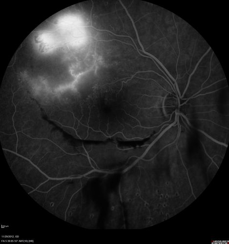 Branch Retinal Vein Occlusion with NVE (Neovascularization Elsewhere)
Late Leakage on FA
