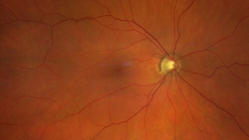BRVO with good vision
87 year old man with good vision (diabetes without retinopathy).  VA 20/25 OU.  Vision never worsened from BRVO OS.
