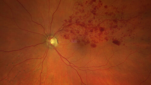 BRVO with good vision
87 year old man with good vision (diabetes without retinopathy).  VA 20/25 OU.  Vision never worsened from BRVO OS.
