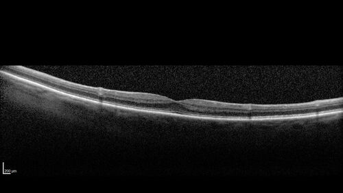 BRVO with good vision
87 year old man with good vision (diabetes without retinopathy).  VA 20/25 OU.  Vision never worsened from BRVO OS.
