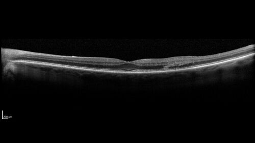 BRVO with good vision
87 year old man with good vision (diabetes without retinopathy).  VA 20/25 OU.  Vision never worsened from BRVO OS.
