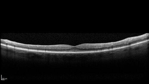 BRVO with good vision
87 year old man with good vision (diabetes without retinopathy).  VA 20/25 OU.  Vision never worsened from BRVO OS.
