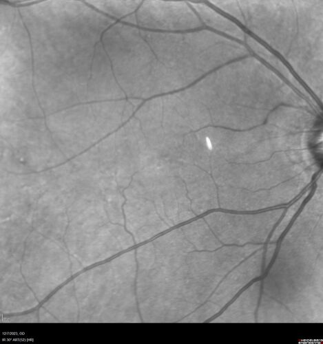 BRVO with good vision
87 year old man with good vision (diabetes without retinopathy).  VA 20/25 OU.  Vision never worsened from BRVO OS.
