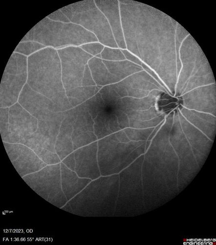 BRVO with good vision
87 year old man with good vision (diabetes without retinopathy).  VA 20/25 OU.  Vision never worsened from BRVO OS.
