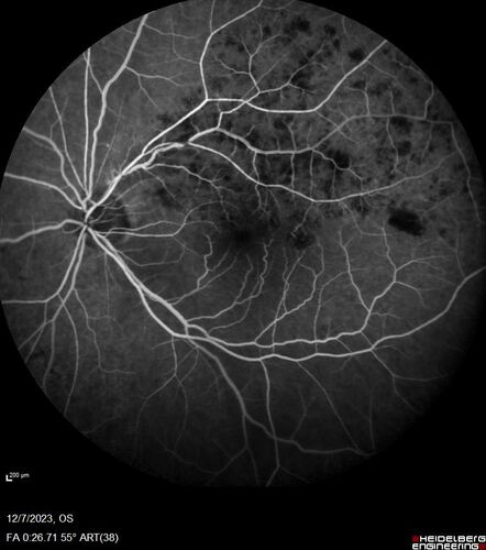BRVO with good vision
87 year old man with good vision (diabetes without retinopathy).  VA 20/25 OU.  Vision never worsened from BRVO OS.
