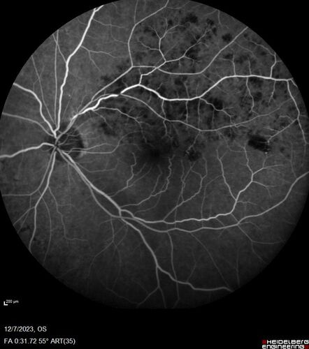 BRVO with good vision
87 year old man with good vision (diabetes without retinopathy).  VA 20/25 OU.  Vision never worsened from BRVO OS.
