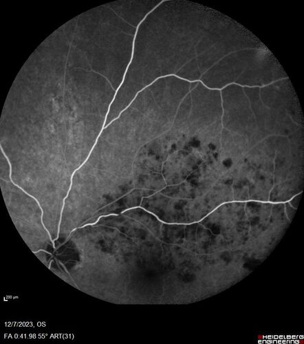 BRVO with good vision
87 year old man with good vision (diabetes without retinopathy).  VA 20/25 OU.  Vision never worsened from BRVO OS.
