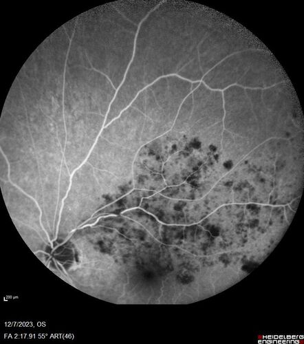 BRVO with good vision
87 year old man with good vision (diabetes without retinopathy).  VA 20/25 OU.  Vision never worsened from BRVO OS.
