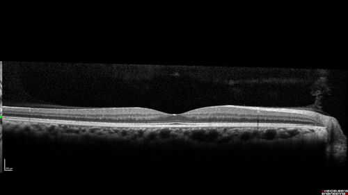 Branch Retinal Vein Occlusion - Foveal Ischemia Neovascularization Non perfusion
38 year  old patient with a BRVO who had PRP laser for vitreous hemorrhage. Vision remained 20/160 from foveal ischemia
