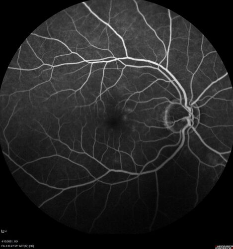 Branch Retinal Vein Occlusion - Foveal Ischemia Neovascularization Non perfusion
38 year  old patient with a BRVO who had PRP laser for vitreous hemorrhage. Vision remained 20/160 from foveal ischemia
