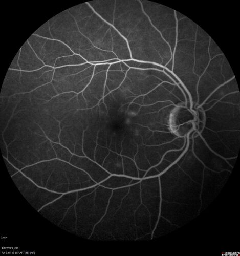Branch Retinal Vein Occlusion - Foveal Ischemia Neovascularization Non perfusion
38 year  old patient with a BRVO who had PRP laser for vitreous hemorrhage. Vision remained 20/160 from foveal ischemia
