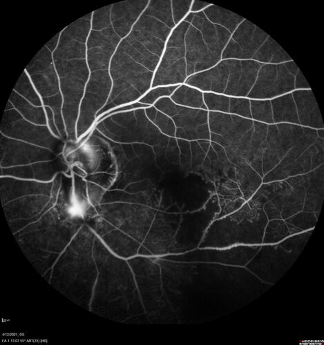 Branch Retinal Vein Occlusion - Foveal Ischemia Neovascularization Non perfusion
38 year  old patient with a BRVO who had PRP laser for vitreous hemorrhage. Vision remained 20/160 from foveal ischemia
