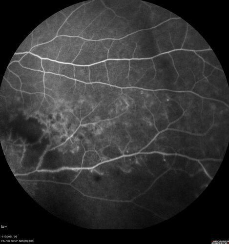 Branch Retinal Vein Occlusion - Foveal Ischemia Neovascularization Non perfusion
38 year  old patient with a BRVO who had PRP laser for vitreous hemorrhage. Vision remained 20/160 from foveal ischemia
