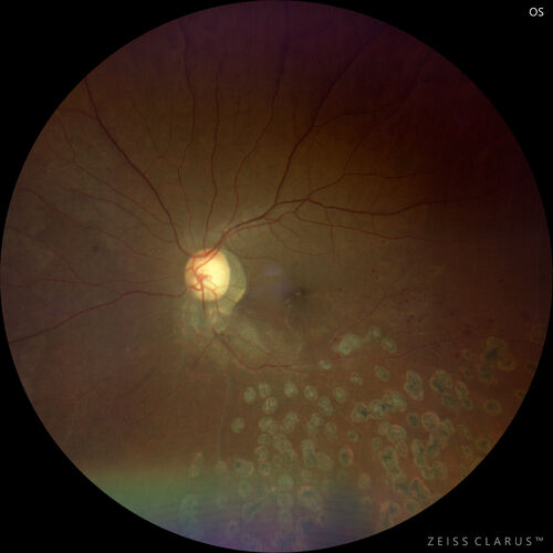 Branch Retinal Vein Occlusion - Foveal Ischemia Neovascularization Non perfusion
38 year  old patient with a BRVO who had PRP laser for vitreous hemorrhage. Vision remained 20/160 from foveal ischemia
