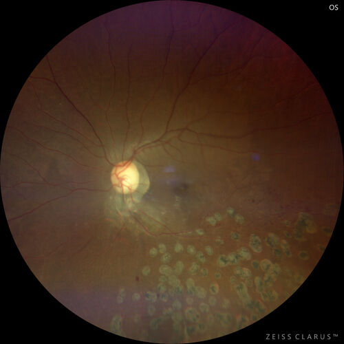 Branch Retinal Vein Occlusion - Foveal Ischemia Neovascularization Non perfusion
38 year  old patient with a BRVO who had PRP laser for vitreous hemorrhage. Vision remained 20/160 from foveal ischemia
