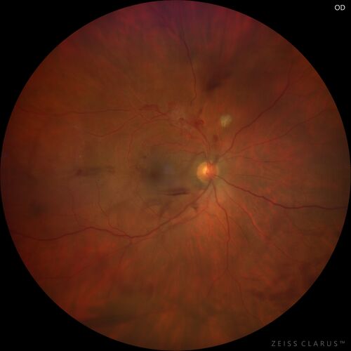 Branch Retinal Vein Occlusion with NVE and vitreous hemorrhage and non-perfusion
50 year old man The right eye was fine and then there was a sudden change in the vision.Â  When he is outside looking at something bright there are thousands of dots with squiggly lines through them.Â 
PMHx: Type II DM (1 year), HTN, AnemiaÂ 
VA OD: sc20/40 PH20/32 NscJ7
VA OS: sc20/160 PH20/25 NscJ2

Myelinate RNFL in the left eye
