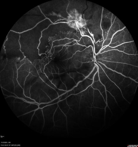 Branch Retinal Vein Occlusion with NVE and vitreous hemorrhage and non-perfusion
50 year old man The right eye was fine and then there was a sudden change in the vision.Â  When he is outside looking at something bright there are thousands of dots with squiggly lines through them.Â 
PMHx: Type II DM (1 year), HTN, AnemiaÂ 
VA OD: sc20/40 PH20/32 NscJ7
VA OS: sc20/160 PH20/25 NscJ2

Myelinate RNFL in the left eye
