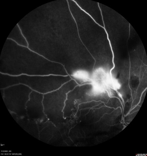 Branch Retinal Vein Occlusion with NVE and vitreous hemorrhage and non-perfusion
50 year old man The right eye was fine and then there was a sudden change in the vision.Â  When he is outside looking at something bright there are thousands of dots with squiggly lines through them.Â 
PMHx: Type II DM (1 year), HTN, AnemiaÂ 
VA OD: sc20/40 PH20/32 NscJ7
VA OS: sc20/160 PH20/25 NscJ2

Myelinate RNFL in the left eye
