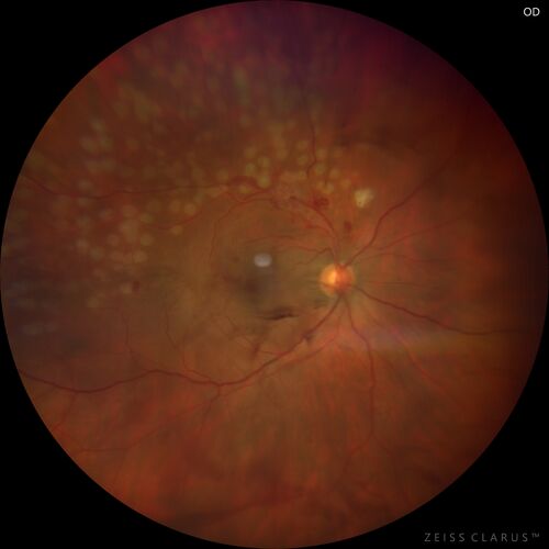 Branch Retinal Vein Occlusion with NVE and vitreous hemorrhage and non-perfusion
50 year old man The right eye was fine and then there was a sudden change in the vision.Â  When he is outside looking at something bright there are thousands of dots with squiggly lines through them.Â 
PMHx: Type II DM (1 year), HTN, AnemiaÂ 
VA OD: sc20/40 PH20/32 NscJ7
VA OS: sc20/160 PH20/25 NscJ2

Myelinate RNFL in the left eye
