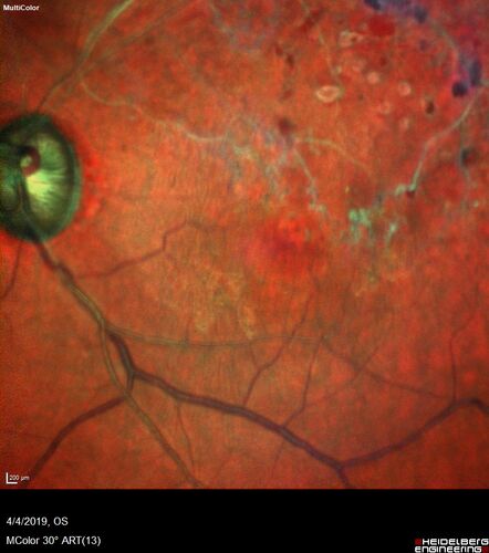 Branch Retinal Vein Occlusion - Both Eyes - Edema OD and NVE OS - Severe Non-perfusion Both Eyes
83 year old man with vision loss for 3 months not sure which eye.  VA 20/100 OD and 20/50 OS.  Tried avastin once without much improvement in the right eye and then lost to follow-up.  FA in the left eye shows leaking NVE

