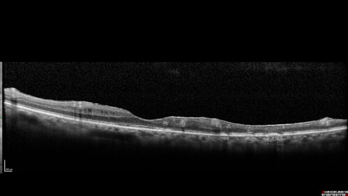 Branch Retinal Vein Occlusion - Both Eyes - Edema OD and NVE OS - Severe Non-perfusion Both Eyes
83 year old man with vision loss for 3 months not sure which eye.  VA 20/100 OD and 20/50 OS.  Tried avastin once without much improvement in the right eye and then lost to follow-up.  FA in the left eye shows leaking NVE

