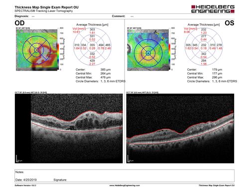 Branch Retinal Vein Occlusion - Both Eyes - Edema OD and NVE OS - Severe Non-perfusion Both Eyes
83 year old man with vision loss for 3 months not sure which eye.  VA 20/100 OD and 20/50 OS.  Tried avastin once without much improvement in the right eye and then lost to follow-up.  FA in the left eye shows leaking NVE
