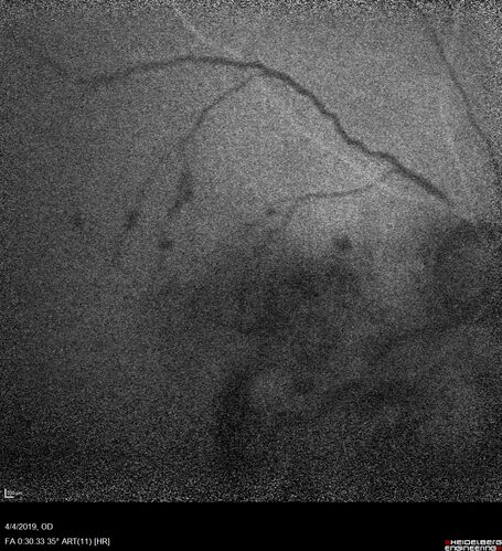 Branch Retinal Vein Occlusion - Both Eyes - Edema OD and NVE OS - Severe Non-perfusion Both Eyes
83 year old man with vision loss for 3 months not sure which eye.  VA 20/100 OD and 20/50 OS.  Tried avastin once without much improvement in the right eye and then lost to follow-up.  FA in the left eye shows leaking NVE
