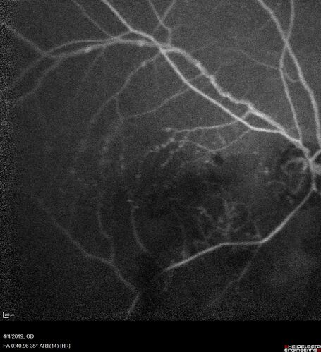 Branch Retinal Vein Occlusion - Both Eyes - Edema OD and NVE OS - Severe Non-perfusion Both Eyes
83 year old man with vision loss for 3 months not sure which eye.  VA 20/100 OD and 20/50 OS.  Tried avastin once without much improvement in the right eye and then lost to follow-up.  FA in the left eye shows leaking NVE
