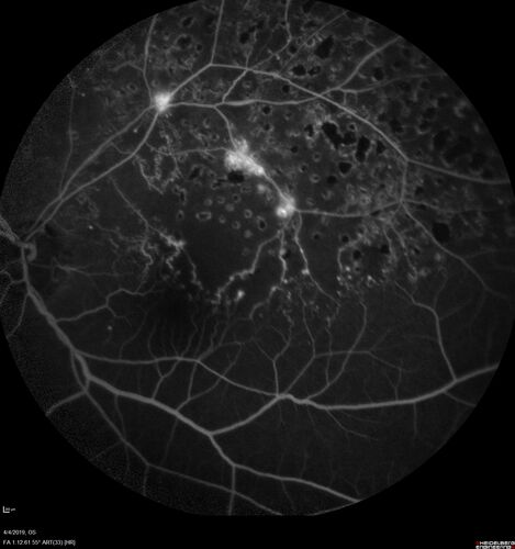 Branch Retinal Vein Occlusion - Both Eyes - Edema OD and NVE OS - Severe Non-perfusion Both Eyes
83 year old man with vision loss for 3 months not sure which eye.  VA 20/100 OD and 20/50 OS.  Tried avastin once without much improvement in the right eye and then lost to follow-up.  FA in the left eye shows leaking NVE
