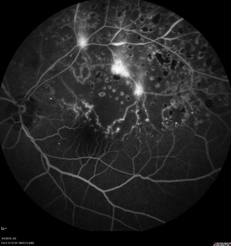 Branch Retinal Vein Occlusion - Both Eyes - Edema OD and NVE OS - Severe Non-perfusion Both Eyes
83 year old man with vision loss for 3 months not sure which eye.  VA 20/100 OD and 20/50 OS.  Tried avastin once without much improvement in the right eye and then lost to follow-up.  FA in the left eye shows leaking NVE
