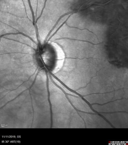 Branch retinal vein occlusion with macular edema
71 year old man Starting about 2 weeks ago the left eye was blurred.  The right eye is seeing well. 
VA OD: sc20/25+2 NccJ1+
VA OS: sc20/63+2 PH20/50-2 Ncc20/400
IOP: TP: OD:19 OS:16
